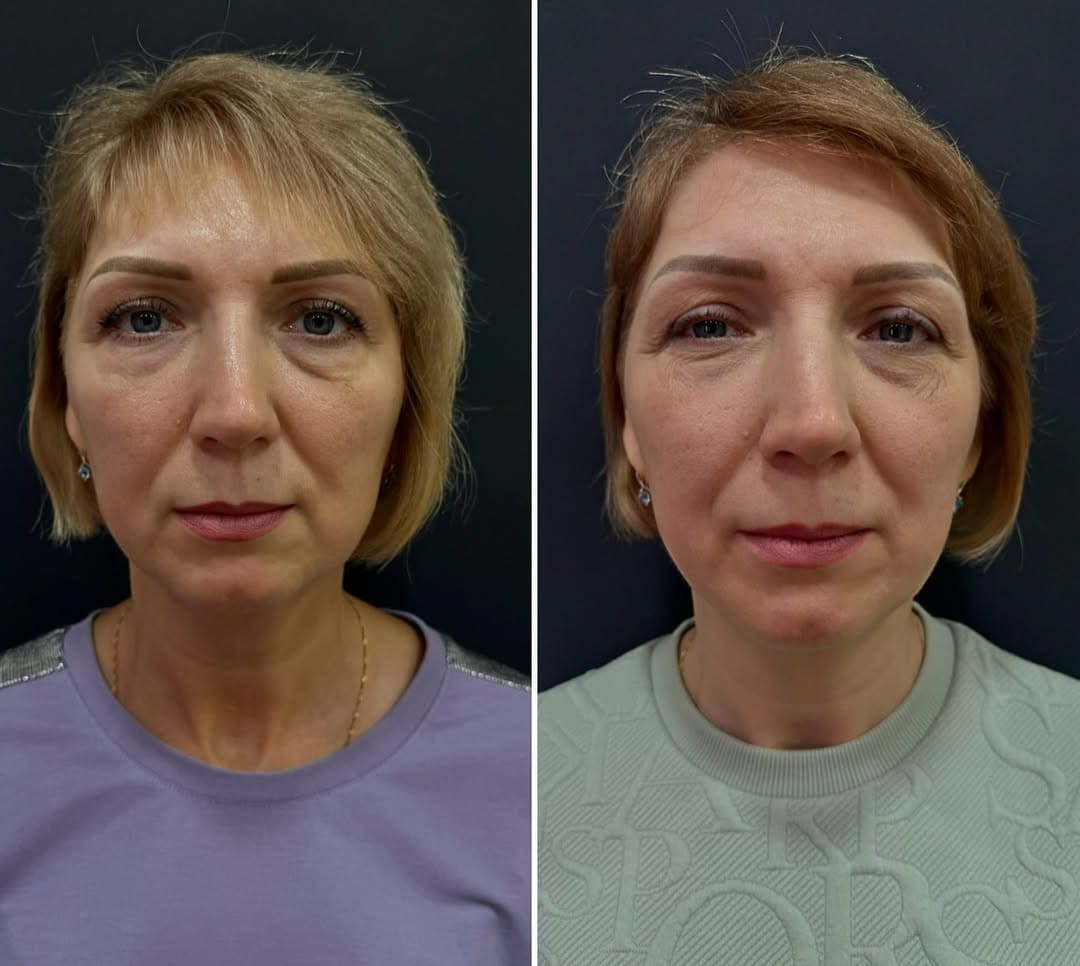 Игольчатый RF-лифтинг Morpheus 8