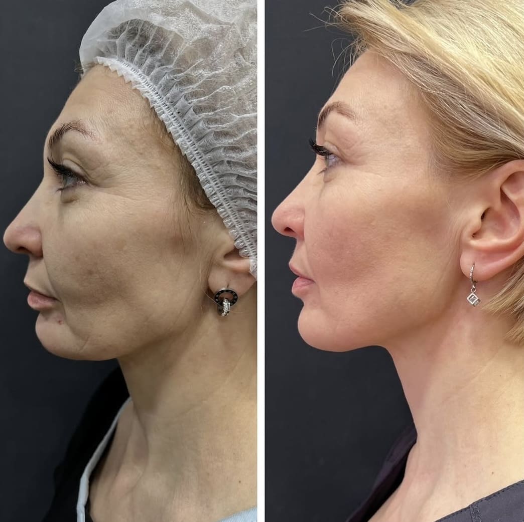 Игольчатый RF-лифтинг Morpheus 8