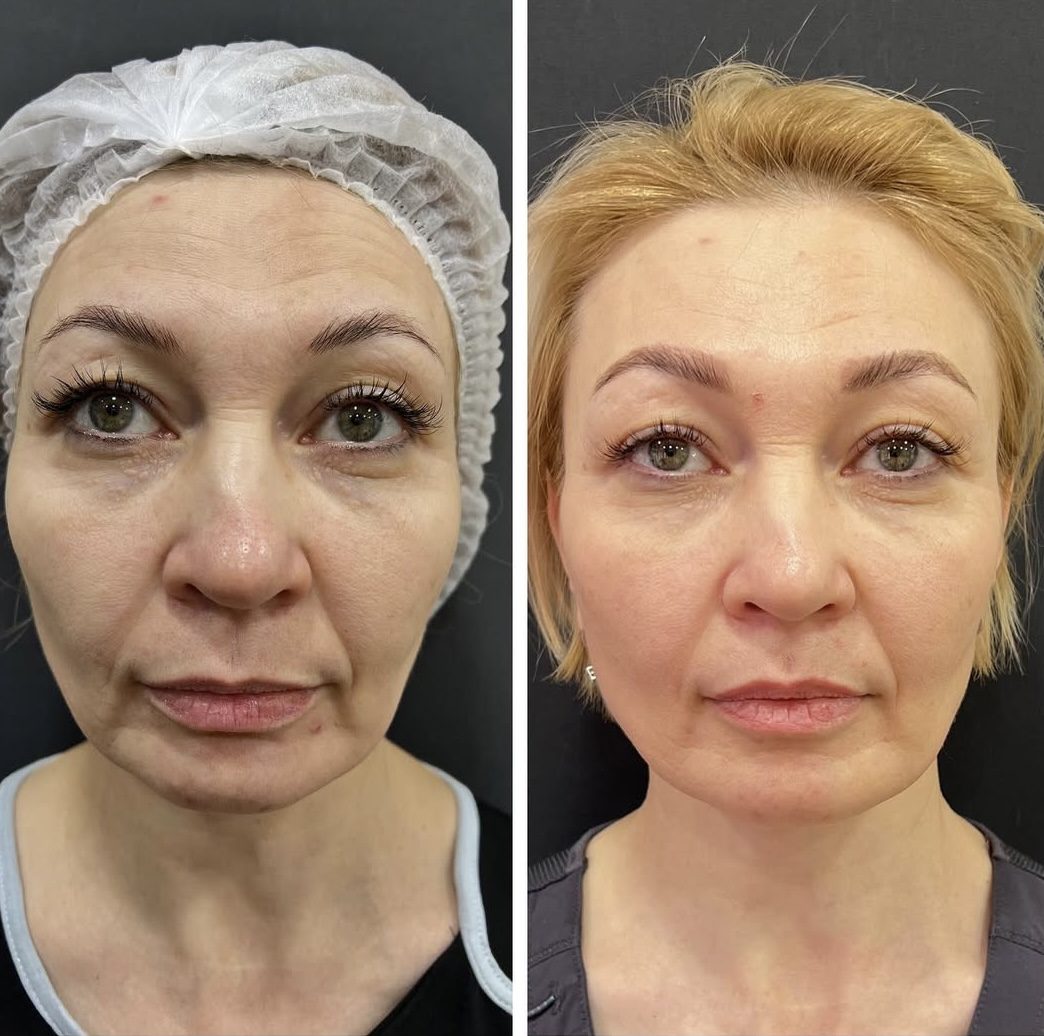 Игольчатый RF-лифтинг Morpheus 8