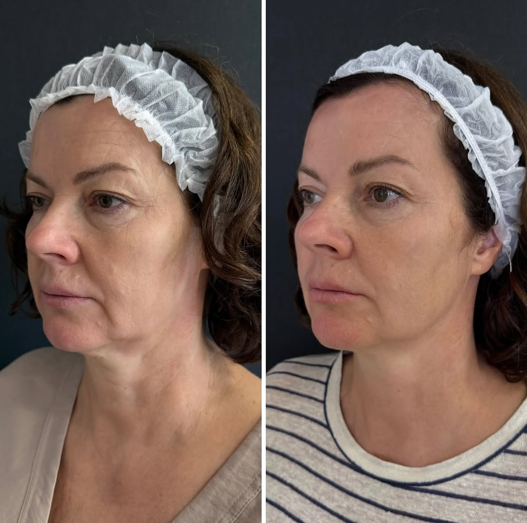 Игольчатый RF-лифтинг Morpheus 8