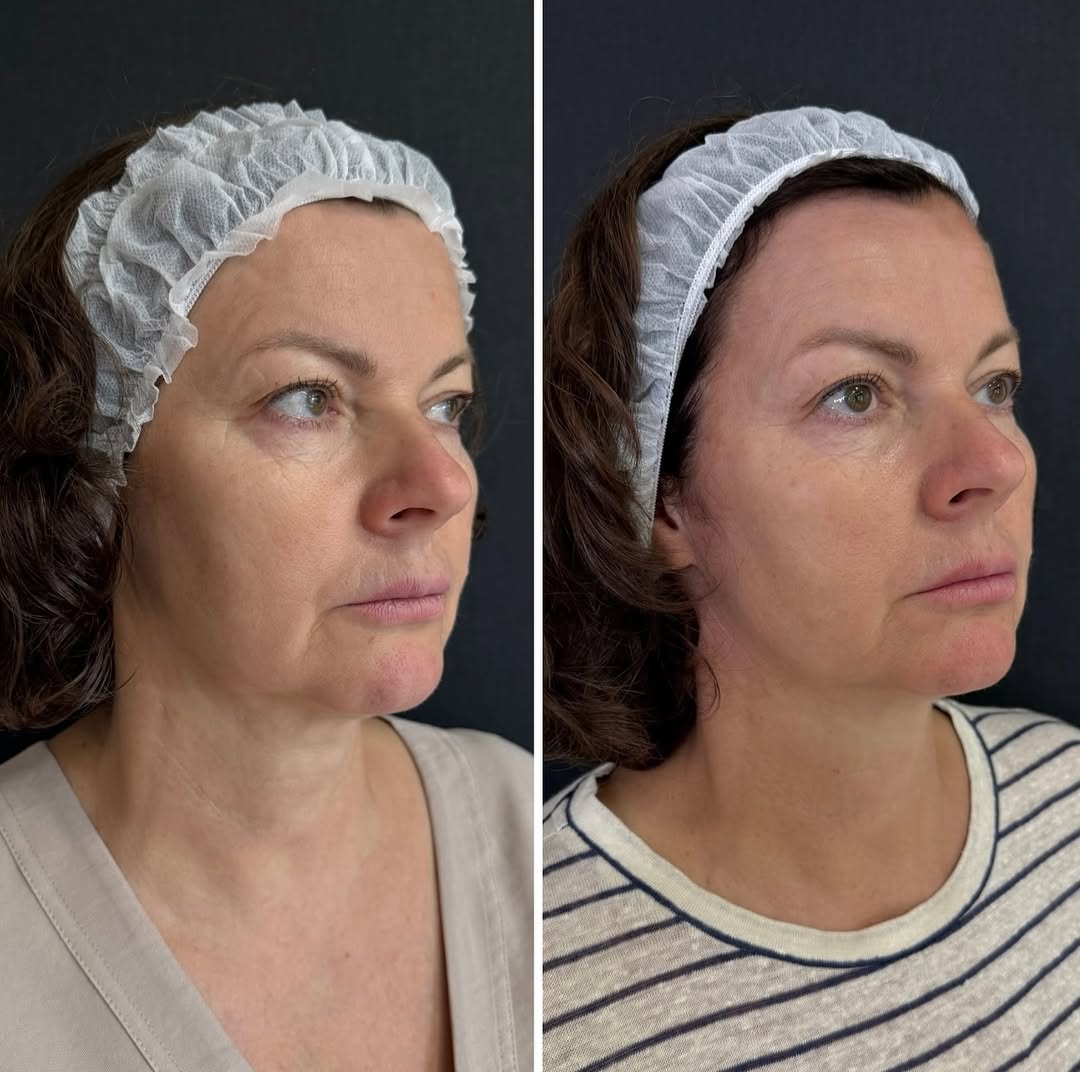 Игольчатый RF-лифтинг Morpheus 8