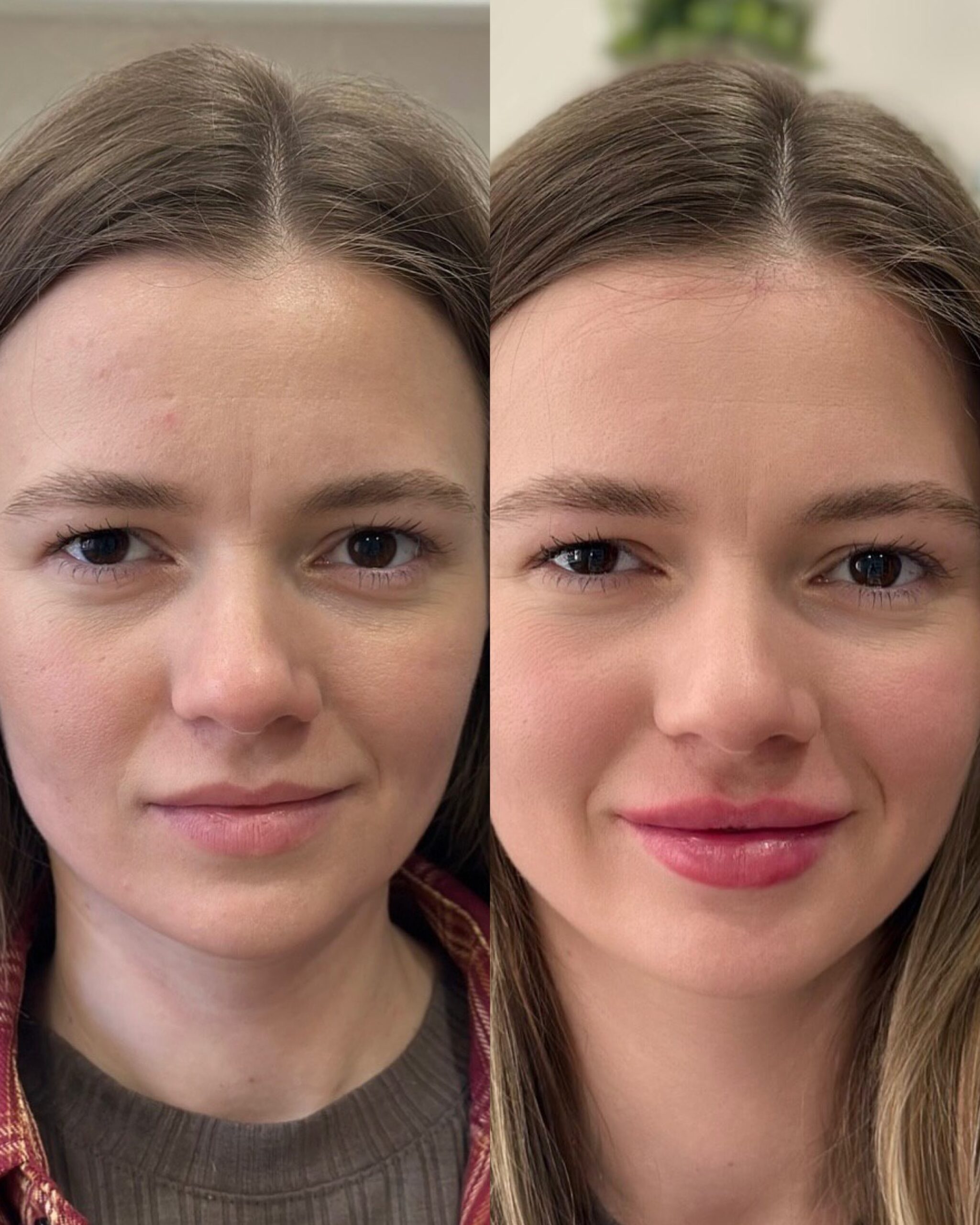 Контурная пластика губ