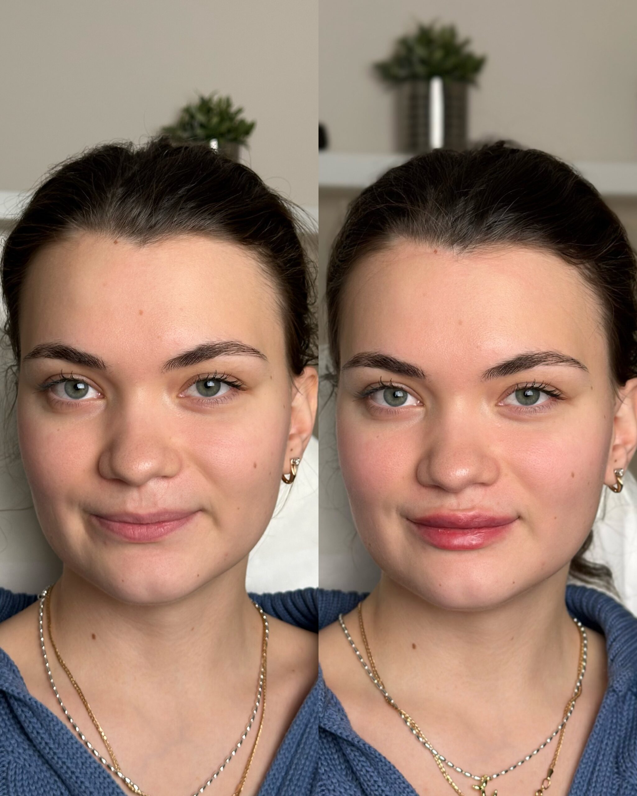 Контурная пластика губ