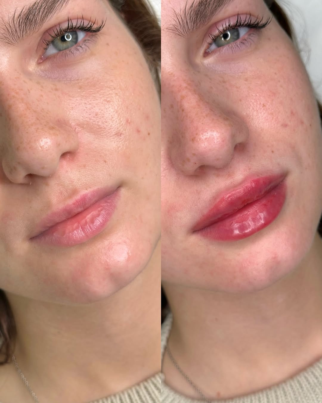 Контурная пластика губ