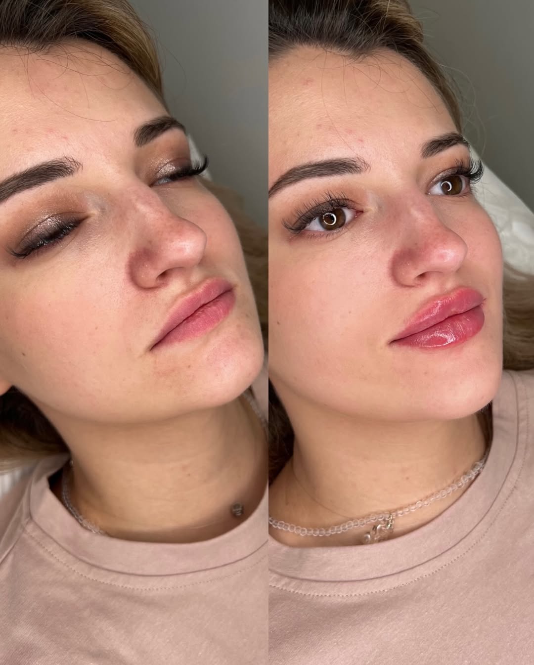 Контурная пластика губ