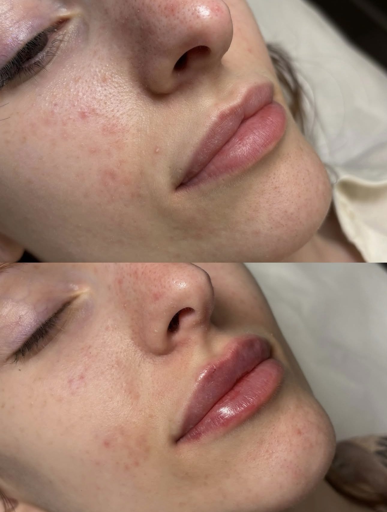 Контурная пластика губ