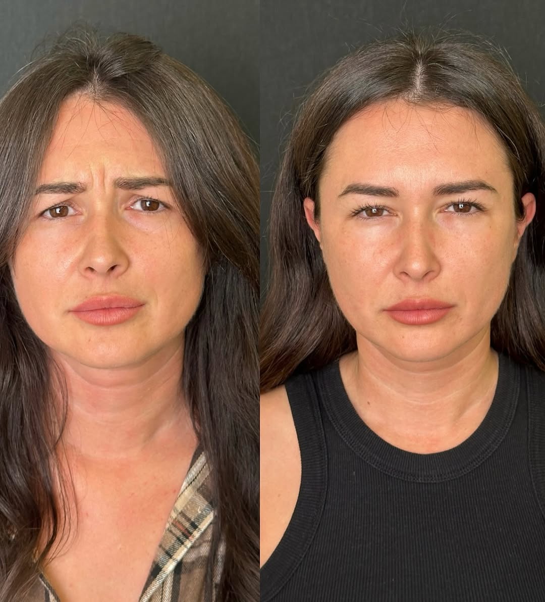 Коррекция морщин препаратом Диспорт