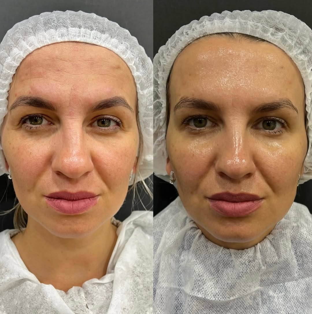 Коррекция морщин препаратом Диспорт