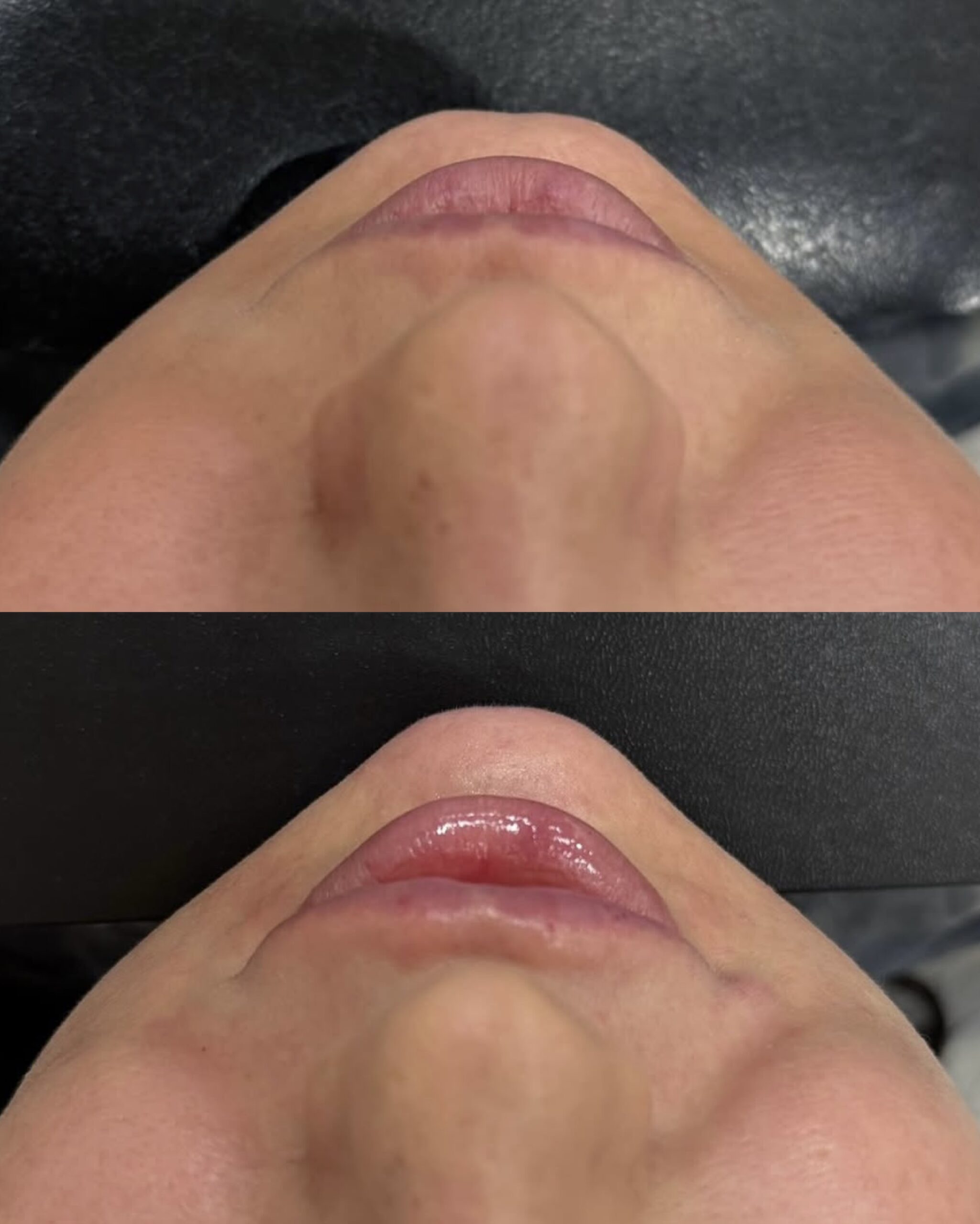 Коррекция подбородка