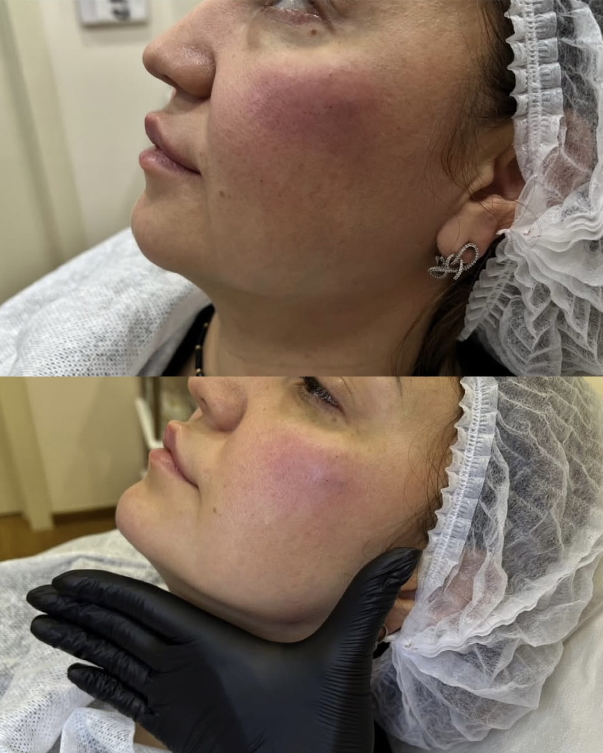 Коррекция углов нижней челюсти